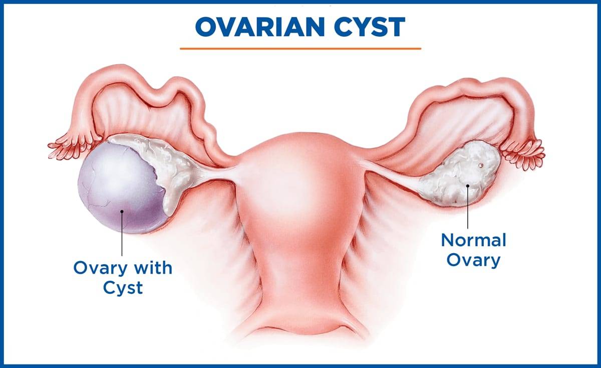 Ovarian Cystectomy